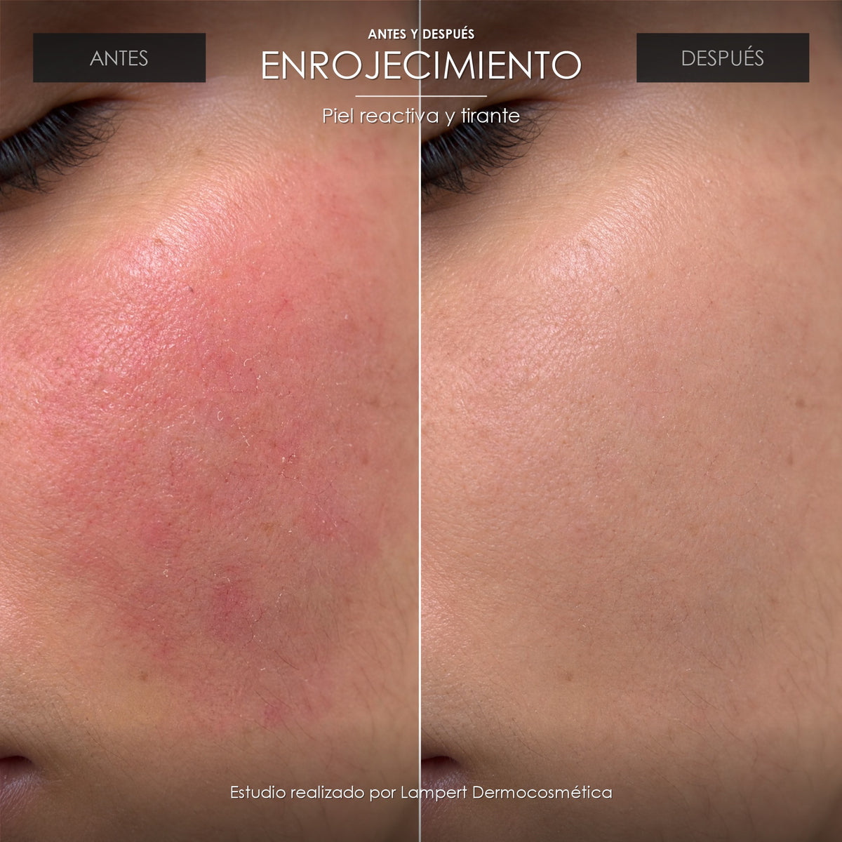 Antes y después: enrojecimiento con Tónico de Aloe Vera Lampert